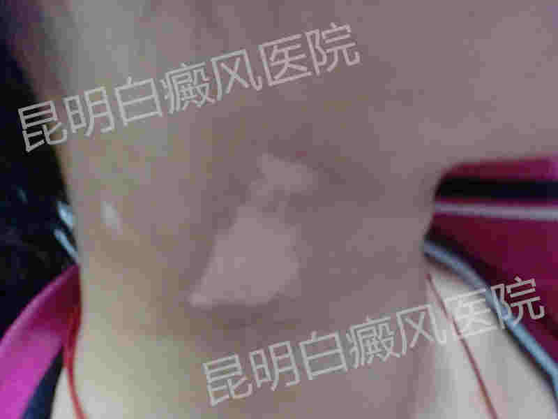 17岁女性颈部患白癜风2年