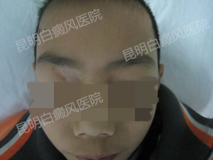 面部及腰部白斑1年