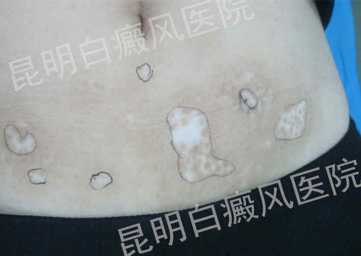 29岁女性腹部白癜风2年