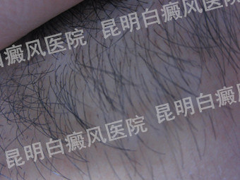 男性后颈部白癜风半年