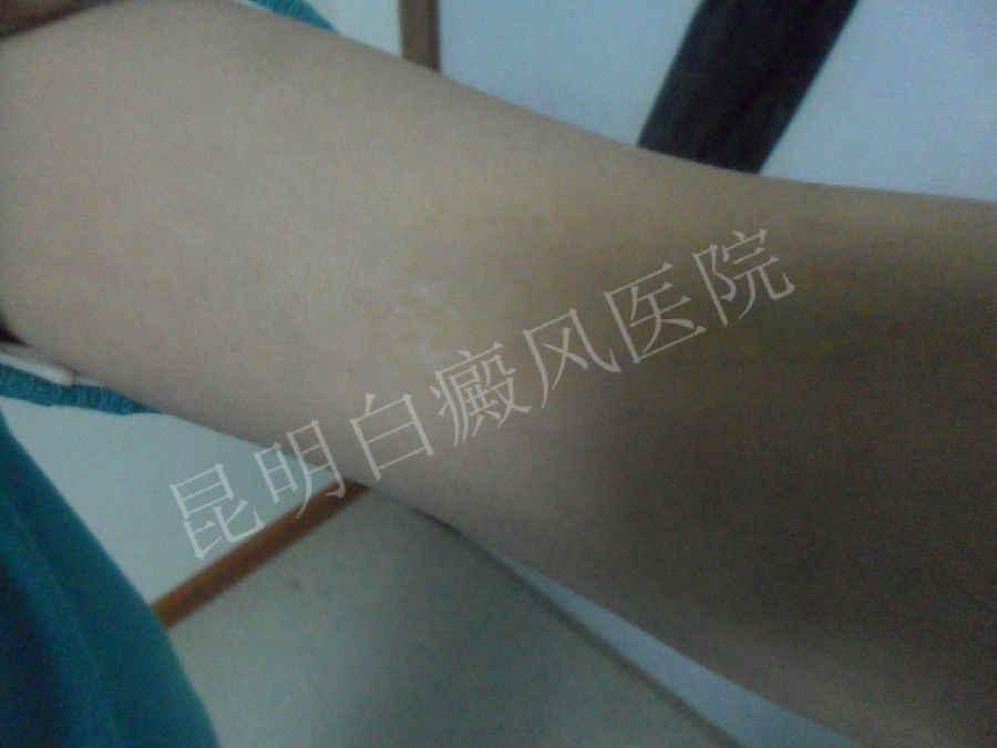 17岁女性胳膊患白癜风1年
