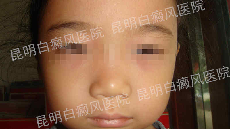 8岁女孩眼角白癜风半年