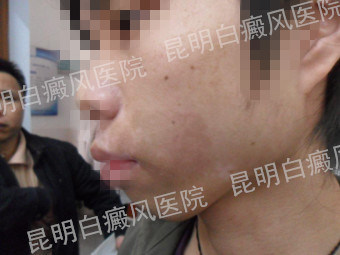男性左侧脸部局限型白癜风1年