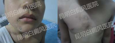 男胸部、颈部白斑一年半