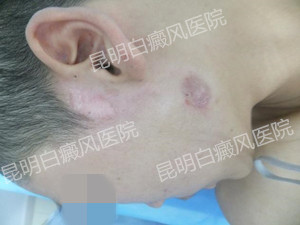 10岁男孩左耳旁白斑一年康复案例