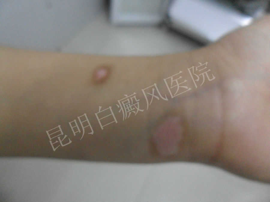 17岁女性胳膊患白癜风1年