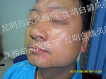 男性脸部局限型白癜风2年