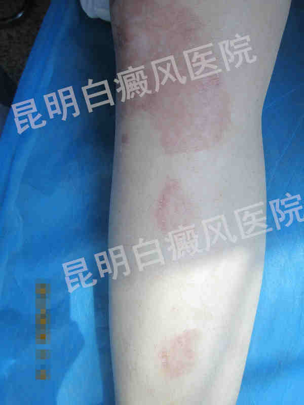 生活如此精彩 岂能因白癜风而毁坏