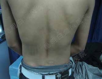 青少年背部白癜风2年