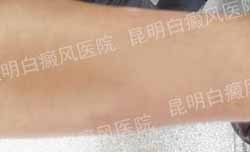 男性手臂块状大面积白斑5年