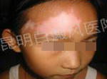 八岁女童额部白斑两月治愈