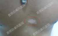 精细化治疗让白斑恢复更快速