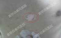 精细化治疗让白斑恢复更快速