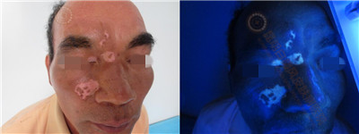 面部白斑三余年,在我院成功治愈