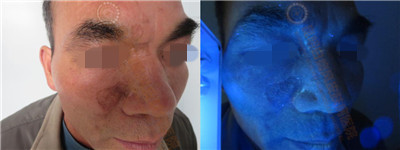 面部白斑三余年,在我院成功治愈