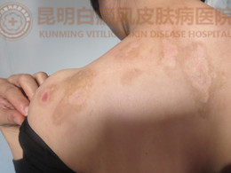 背部白斑一年余,在我院成功治愈