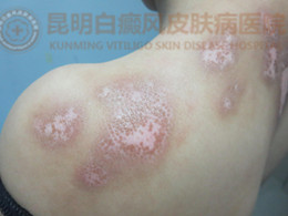 背部白斑一年余,在我院成功治愈