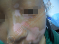 昆明白癜风皮肤病医院——还你花样青春