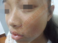 昆明白癜风皮肤病医院——还你花样青春