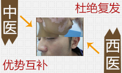 中西医完美的相结合——打开了治疗白癜风之门的终点站