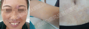 中西医结合治疗白癜风