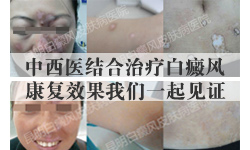 中西医结合治疗白癜风