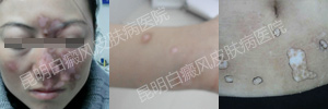 中西医结合治疗白癜风